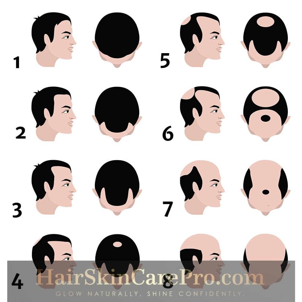 Understanding and Managing a Receding Hairline: A Comprehensive Guide 2025