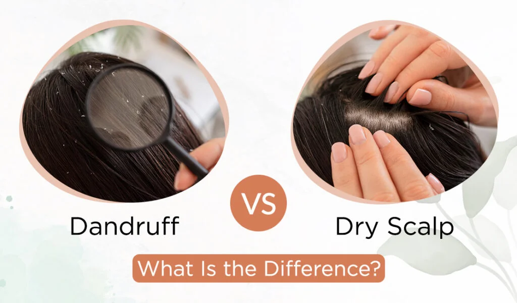 Ultimate Guide to the Best Treatment for Dry Scalp: Expert Tips and Latest Trends in 2025