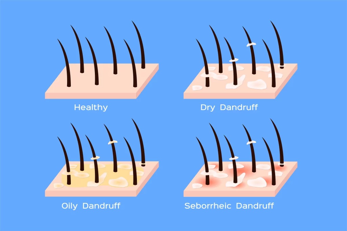 Can Dandruff Make You Lose Your Hair? Understanding the Connection
