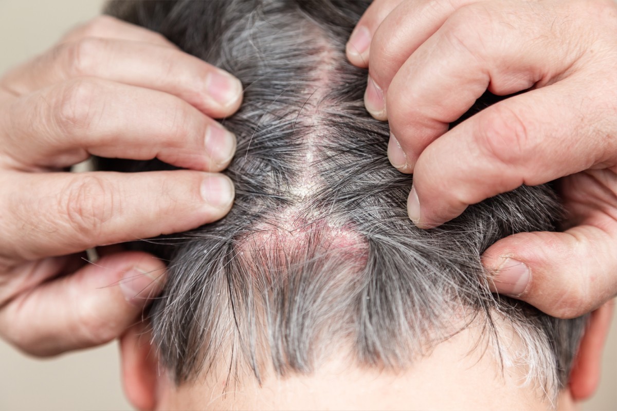 Does Dandruff Cause Hair Loss? Discover the Truth