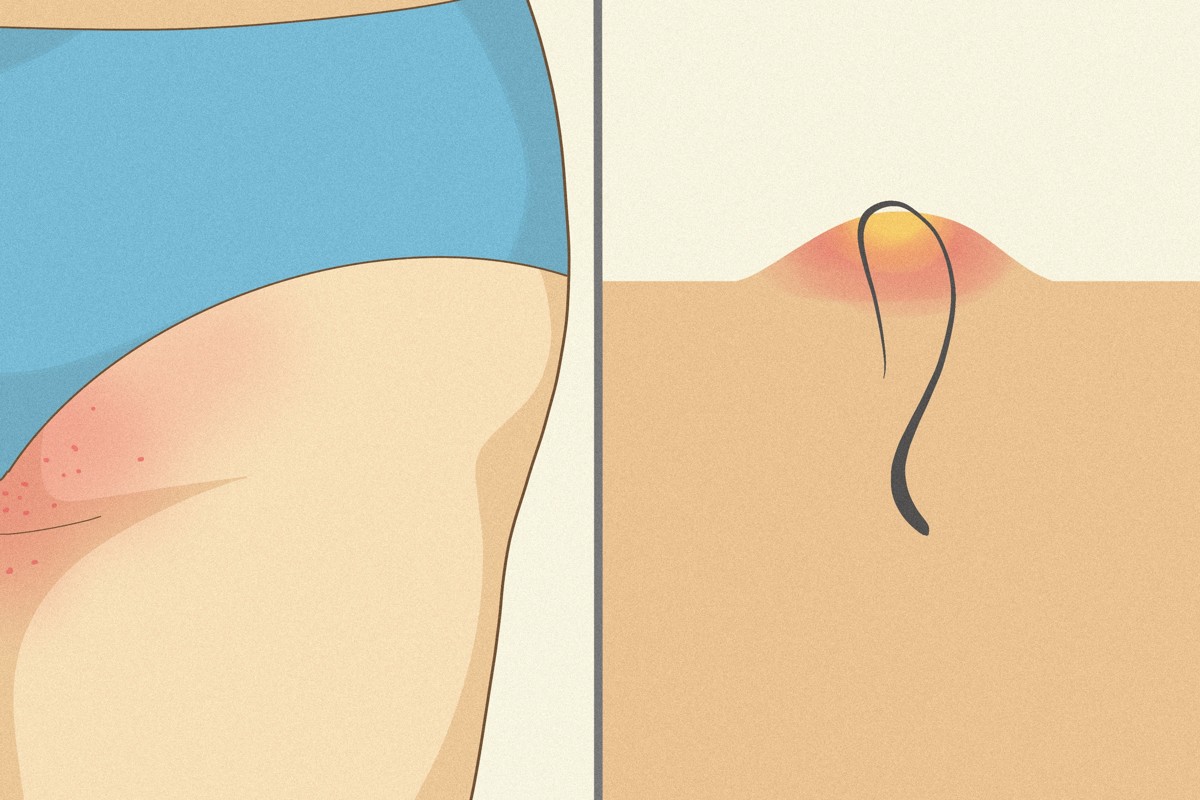 How to Get Rid of Booty Hair: Effective Methods & Tips